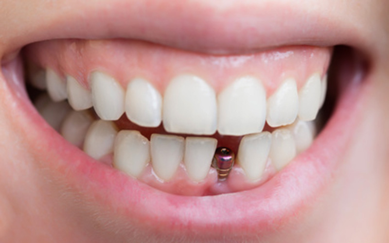 Trusted Dental Implants