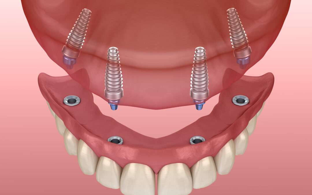 All-On-4: Dental Implants Of Innovation And Restoration