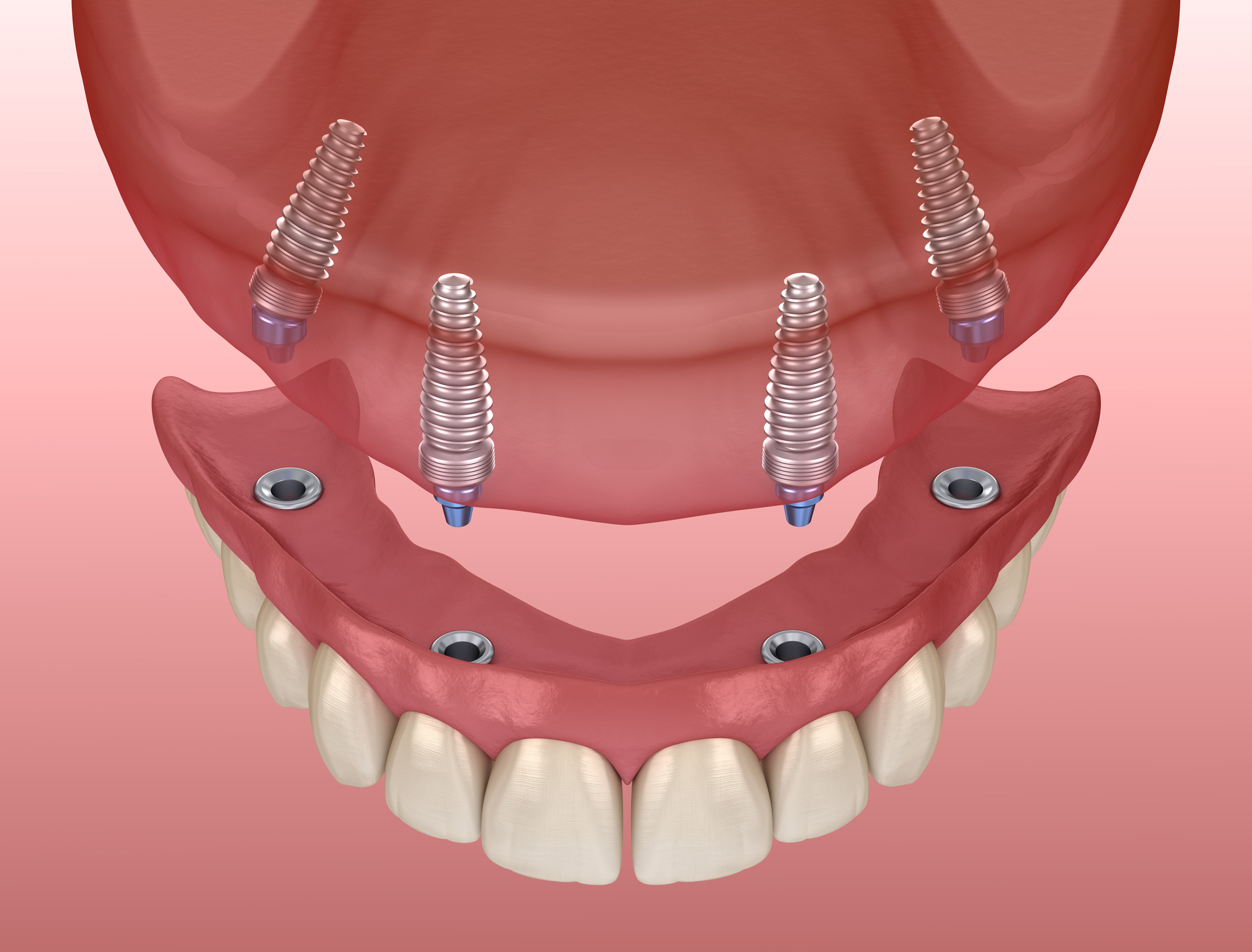 Permanent Dental Implants: Is Titanium a Lifelong Solution?