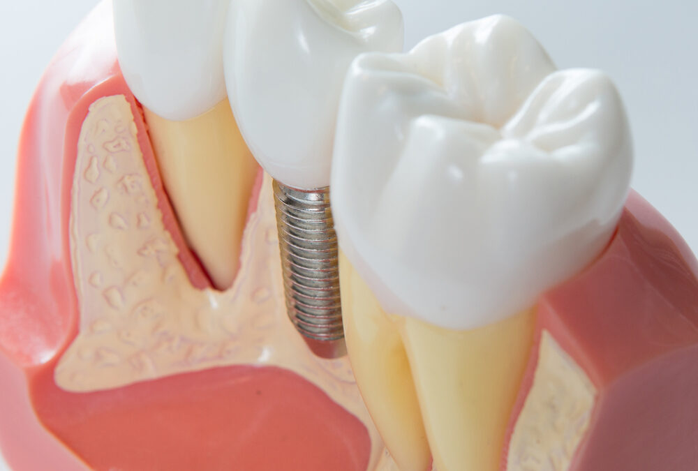 Full Arch On Dental Implants: What Are They?