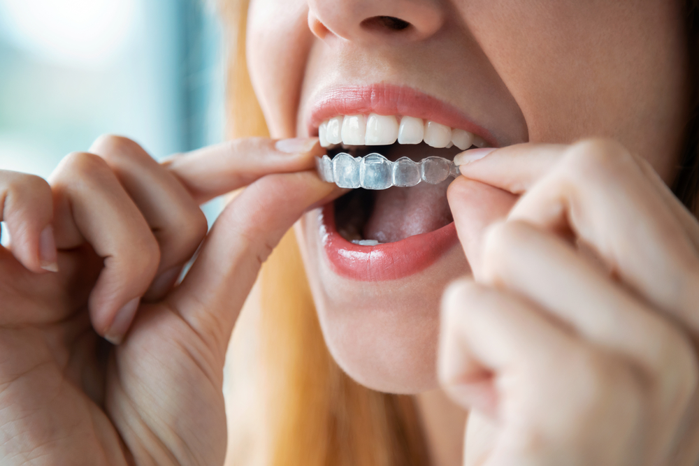 Invisible Orthodontics: Invisalign Dominates Demand