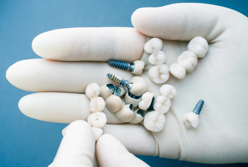 The Dental Implant Process: Step-by-Step from Consultation to Recovery