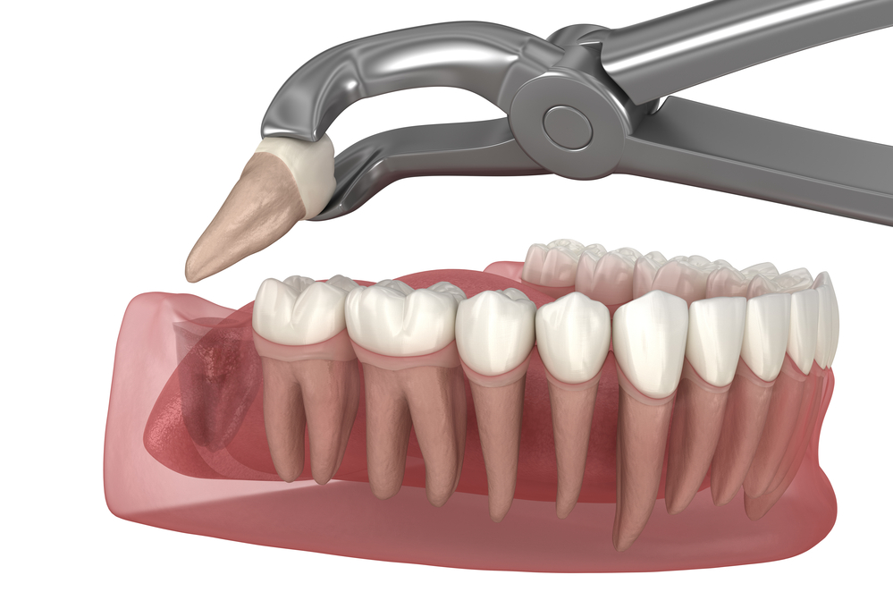 wisdom tooth extraction