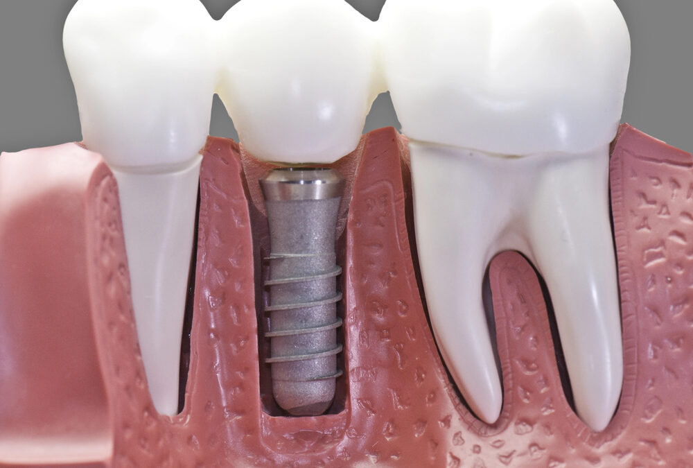Long-Term Benefits of Dental Implants